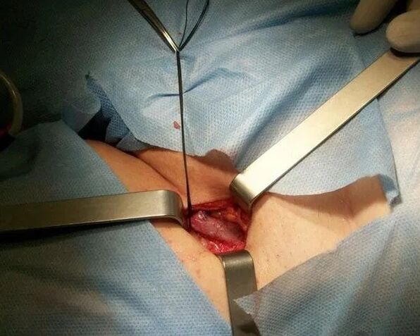 Crosrectomy