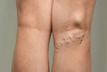 Diagnostika křečových žil u těhotných žen