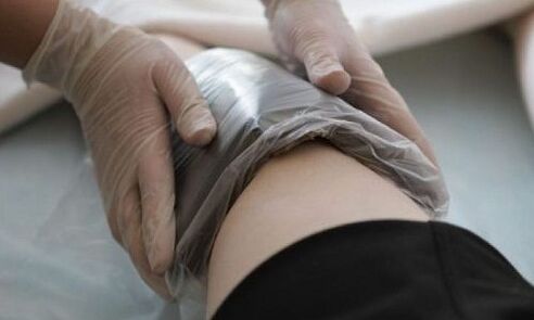 léčba křečových žil obklady