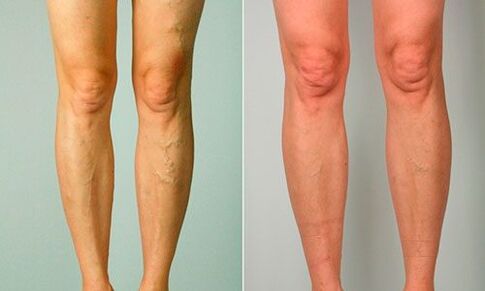 před a po léčbě křečových žil