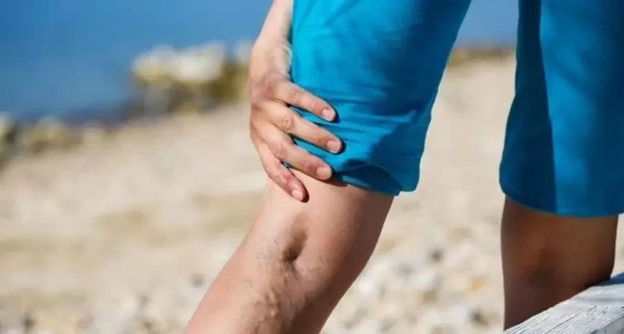 křečové žíly na nohou