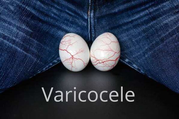 Varikokéla - rozšíření žil semenné šňůry